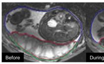 MRI妊娠研究为胎盘研究提供了新的见解