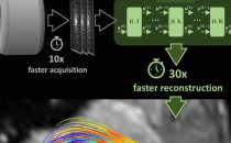 人工智能加速血流磁共振成像 这是怎么回事？